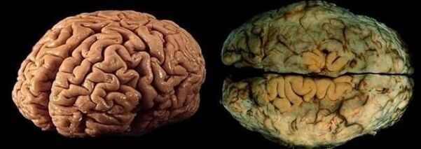 mozak zdrave i pijane osobe